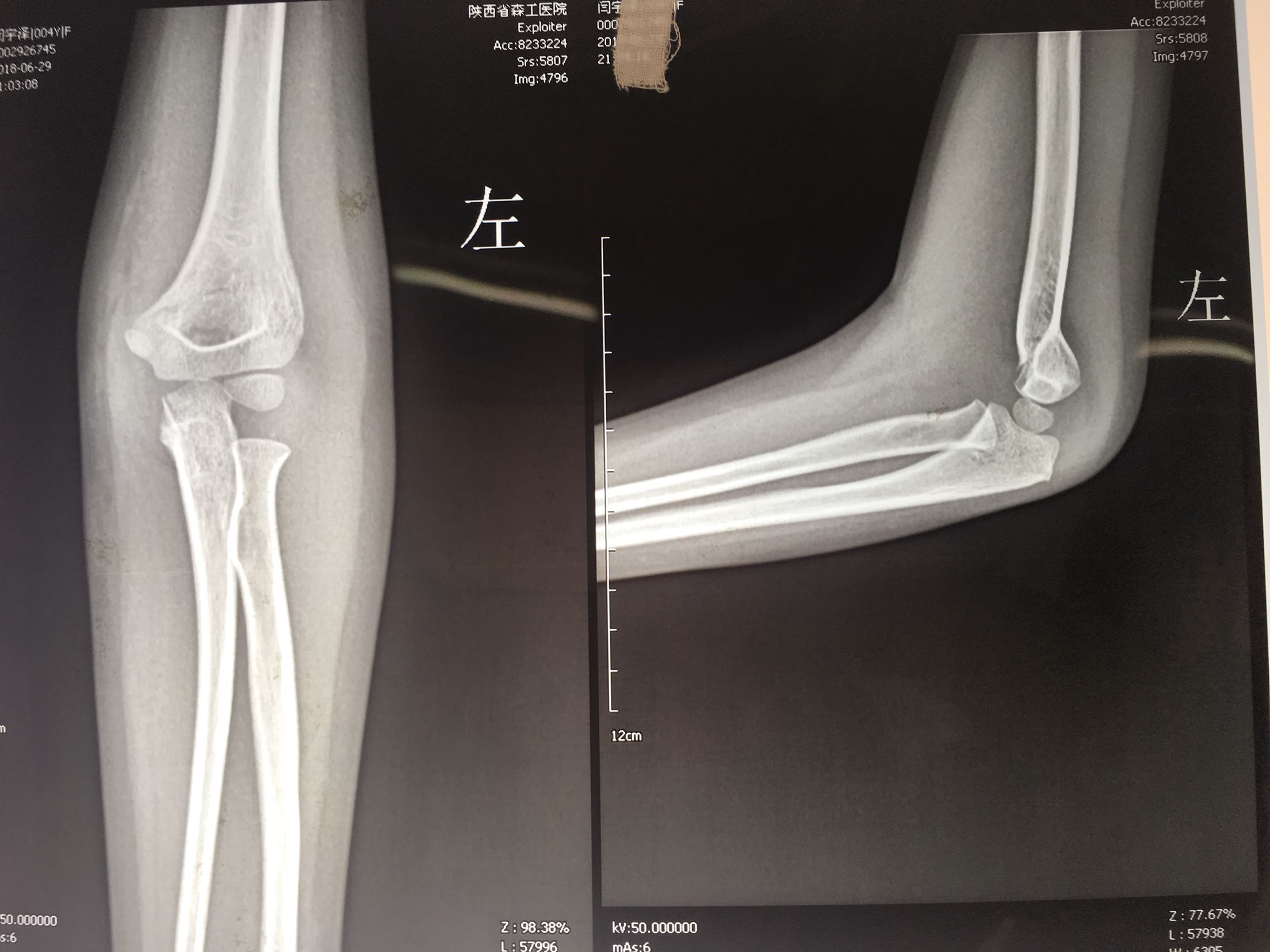 肱骨髁上楔形截骨矫正肘内翻——上海六院保肢专家文根 - 知乎
