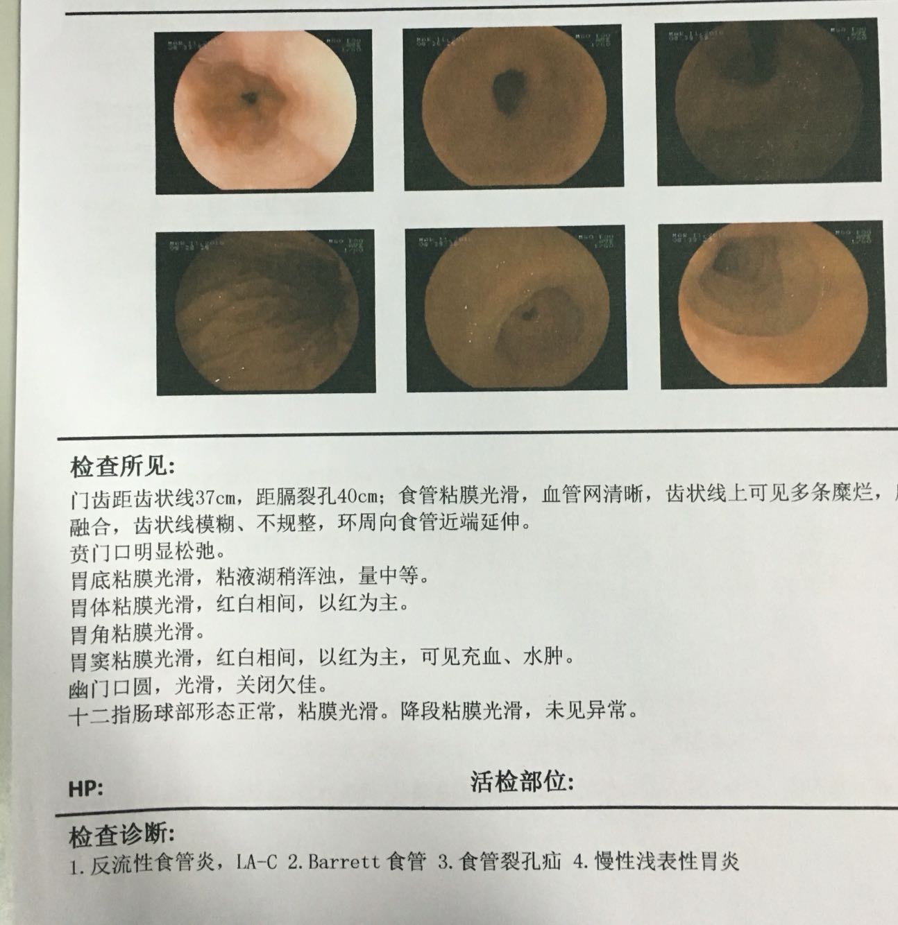 胃肠息肉是怎么长出来的？-京东健康