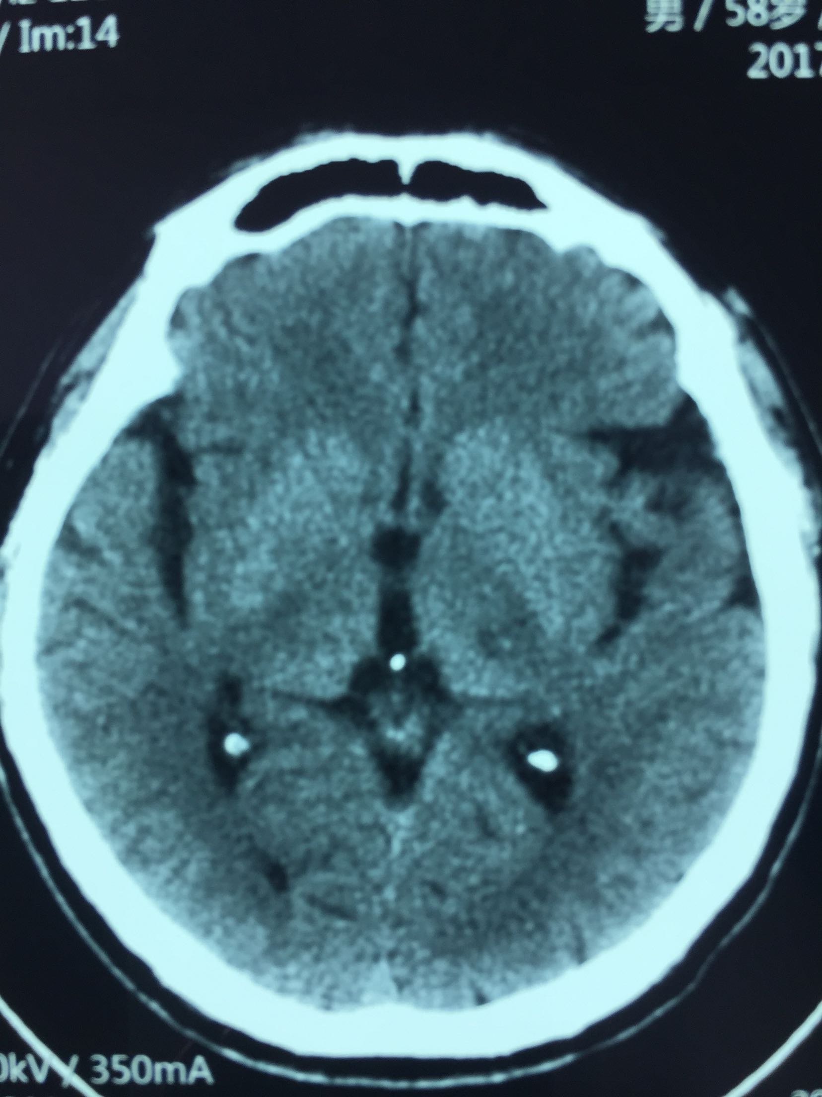 典型脑出血病例分享（含CT及MRI） - 病例中心(诊疗助手) - 爱爱医医学网